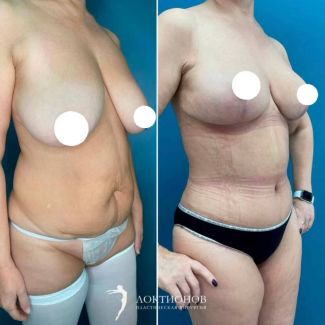 абдоминопластика + липосакция + подтяжка груди без имплантатов - 1 месяц после операции